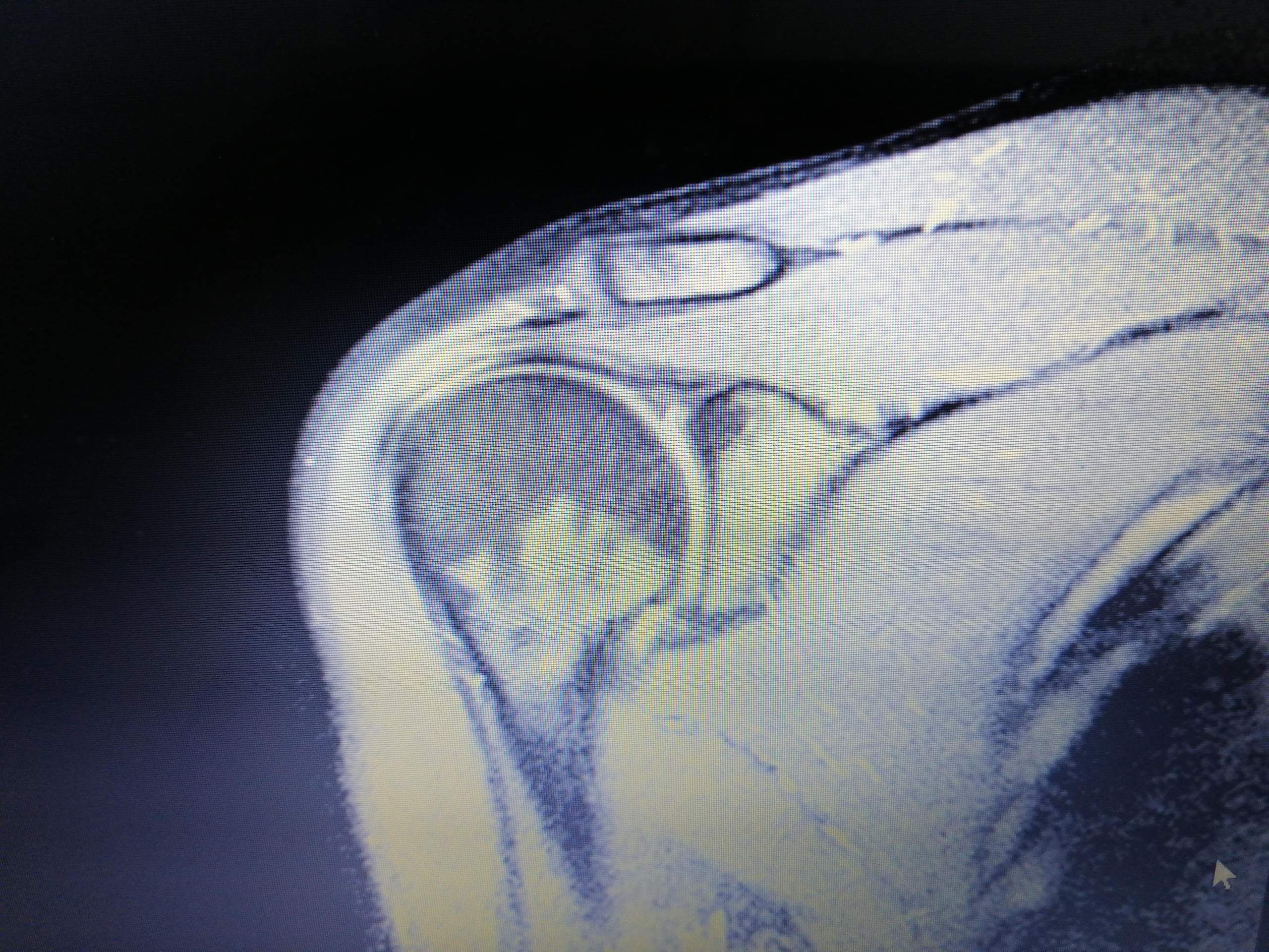 MRT schulter was seht ihr ? (Gesundheit und Medizin, Arzt, Radiologie)
