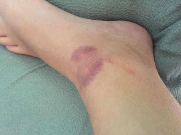 Mucken Stich Ist Das Normal Das Es So Aussieht Fusse Entzundung Bluterguss Mucken Stich Ist Das Normal Das Es So Aussieht Fusse Entzundung Bluterguss