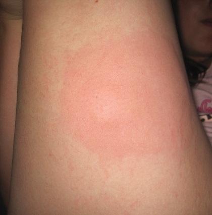 mückenstichallergie... - (Beine, Allergie, Mücken)