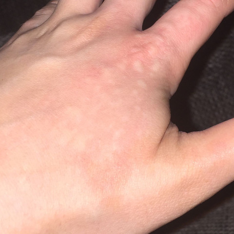 Muckenstich Aussenhender Ausschlag Haut Jucken Muckenstich Aussenhender Ausschlag Haut Jucken