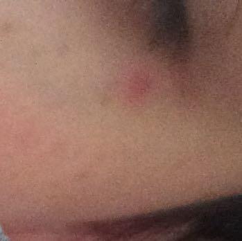 Ich Habe Einen Muckenstich Direkt Neben Dem Auge Was Kann Ich Tun Gesundheit Augen Ich Habe Einen Muckenstich Direkt Neben Dem Auge Was Kann Ich Tun Gesundheit Augen