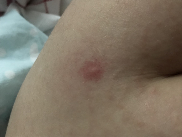 Muckenstich Entzundet Ab Zum Arzt Entzundung Muckenstiche Sepsis Muckenstich Entzundet Ab Zum Arzt Entzundung Muckenstiche Sepsis