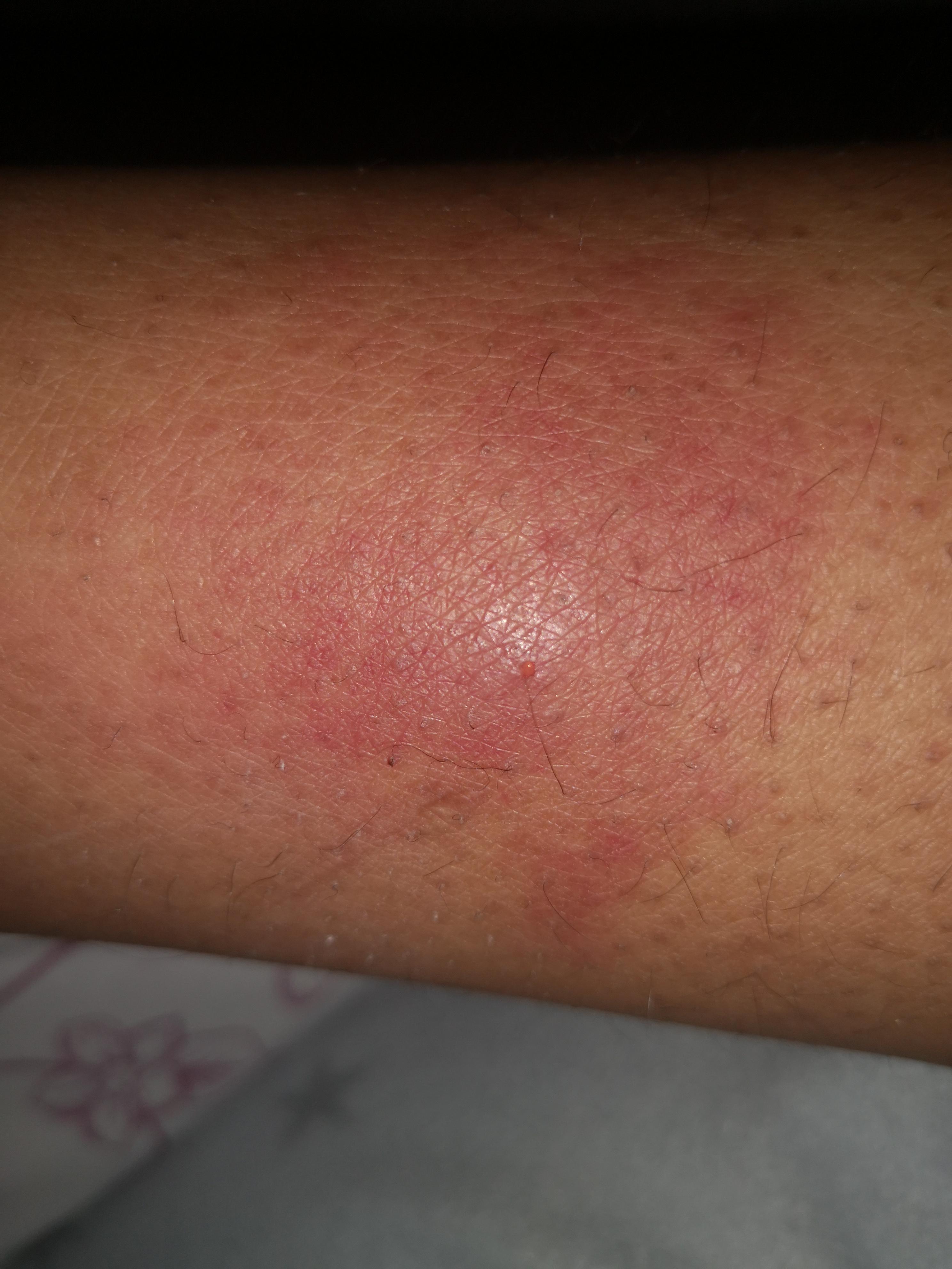 Muckenstich Entzundet Oder Nicht Gesundheit Und Medizin Immunsystem Muckenstiche Muckenstich Entzundet Oder Nicht Gesundheit Und Medizin Immunsystem Muckenstiche