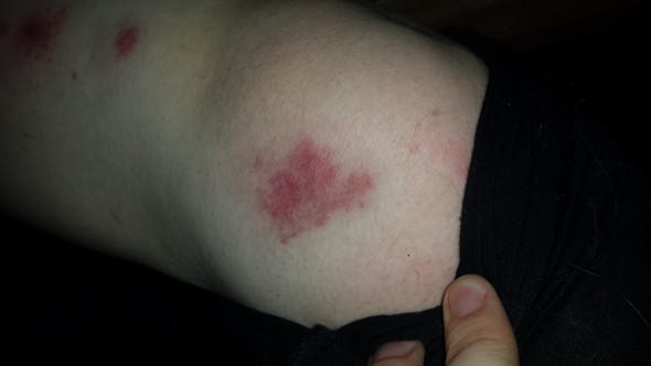 Muckenstich Entzundung Gesundheit Und Medizin Arzt Schmerzen Muckenstich Entzundung Gesundheit Und Medizin Arzt Schmerzen