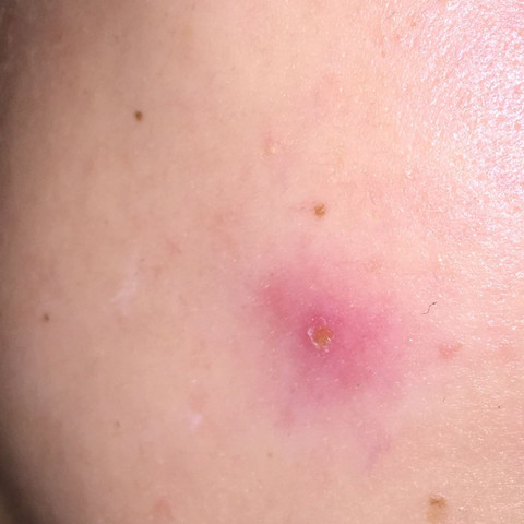 Muckenstich Im Gesicht Aus Versehen Aufgekratzt Was Tun Angst Haut Verletzung