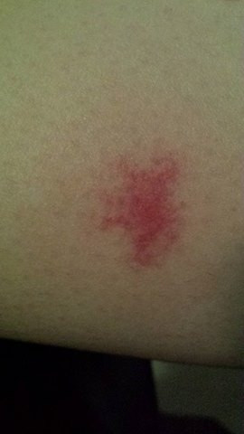 Muckenstich Oder Was Insekten Rot Juckreiz