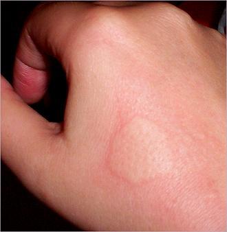 Muckenstichartiger Ausschlag Haut Allergie Muckenstichartiger Ausschlag Haut Allergie