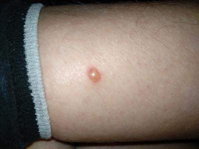 Mückenstiche bilden (gelbliche) Blasen, was kann ich tun? (Gesundheit