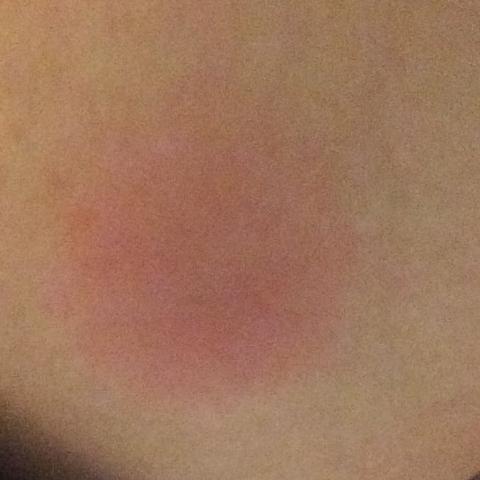 Ist Die Art Der Muckenstiche Normal Italien Mucken