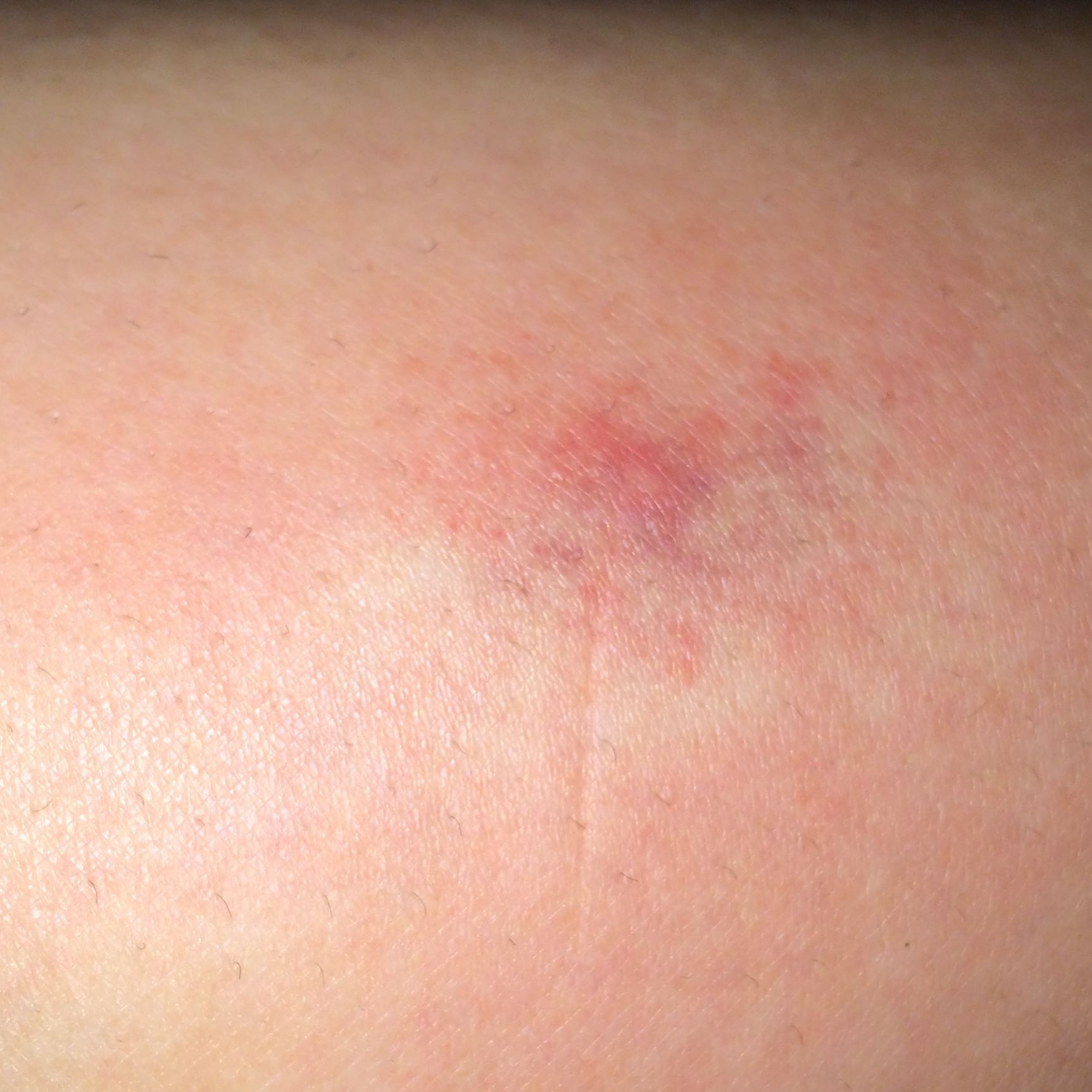 Mückenstich?Zum Arzt? (Verletzung, Juckreiz, Stich)