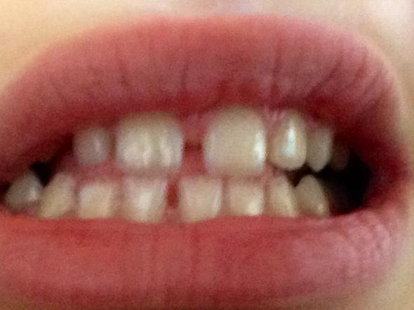 Meine Zähne  - (Zähne, Zahnspange)