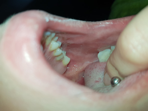 Mundschleimhaut Die Meistgelesenen Fragen Mundschleimhaut Die Meistgelesenen Fragen