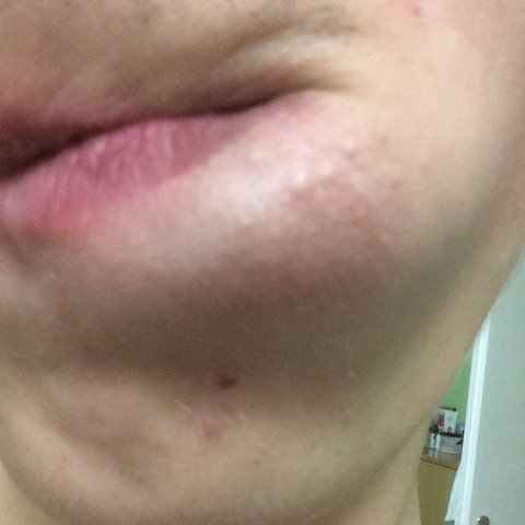 Weiße pickelähnliche Punkte neben den Lippen - (Haut, Pickel, Hygiene)