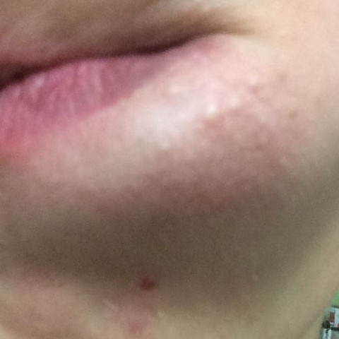 Mund Weisse Punkte Haut Pickel Hygiene Mund Weisse Punkte Haut Pickel Hygiene