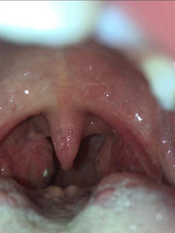 Mundgeruch Hals