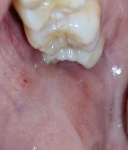 Mundhöhlenkrebs bilder Zunge Krebs
