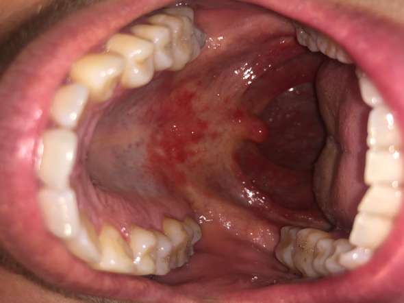 Mundraum Lippen Und Zunge Entzundet Was Konnte Es Sein Gesundheit Und Medizin Gesundheit Zahnarzt Mundraum Lippen Und Zunge Entzundet Was Konnte Es Sein Gesundheit Und Medizin Gesundheit Zahnarzt