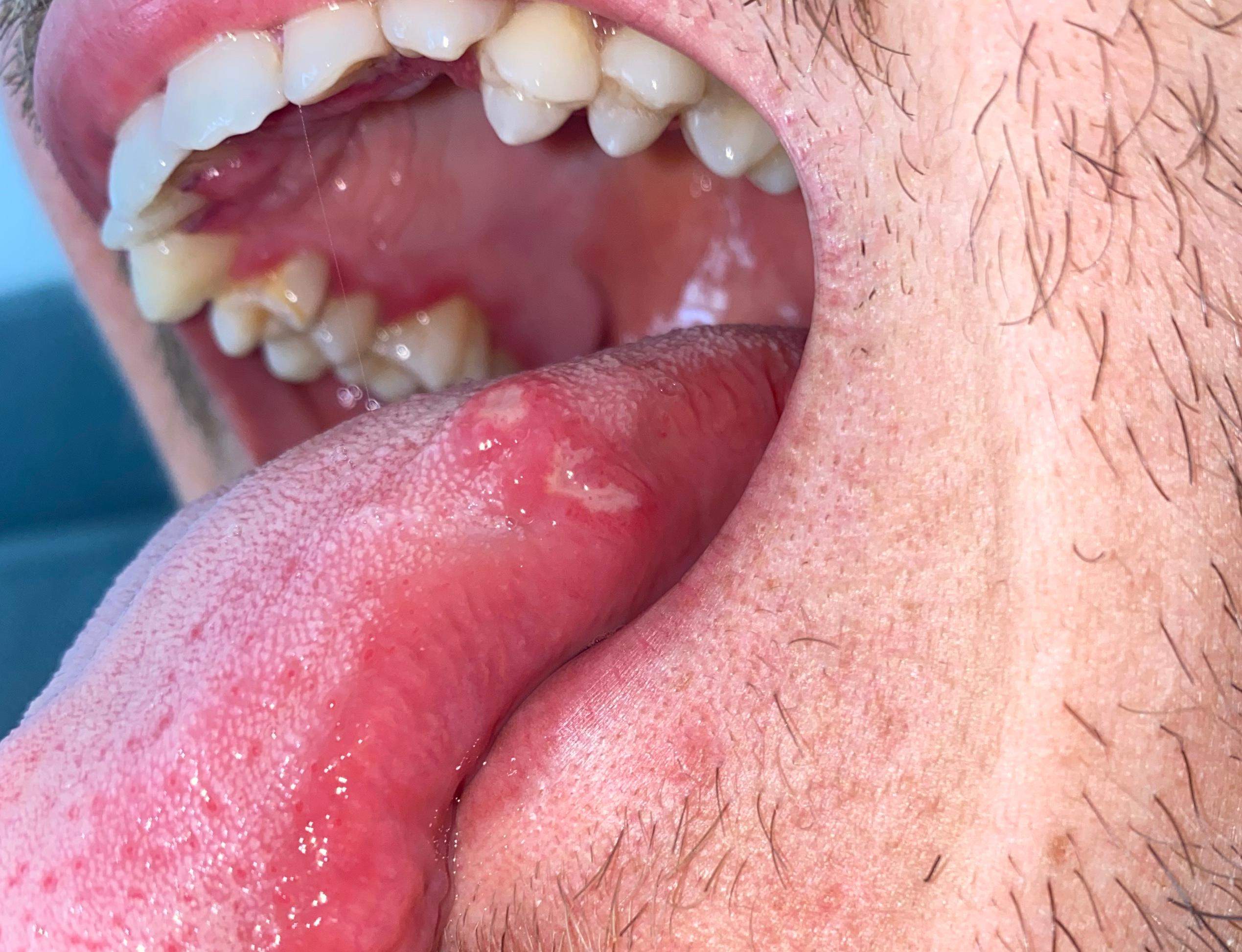 Mundschleimhaut & Zunge komplett entzündet? (Gesundheit und Medizin, Gesundheit, Entzündung)