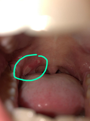 Mundschleimhaut Entzundung Nach Weisheitszahn Op Gesundheit Und Medizin Weisheitszahne Op Apthe Mundschleimhaut Entzundung Nach Weisheitszahn Op Gesundheit Und Medizin Weisheitszahne Op Apthe