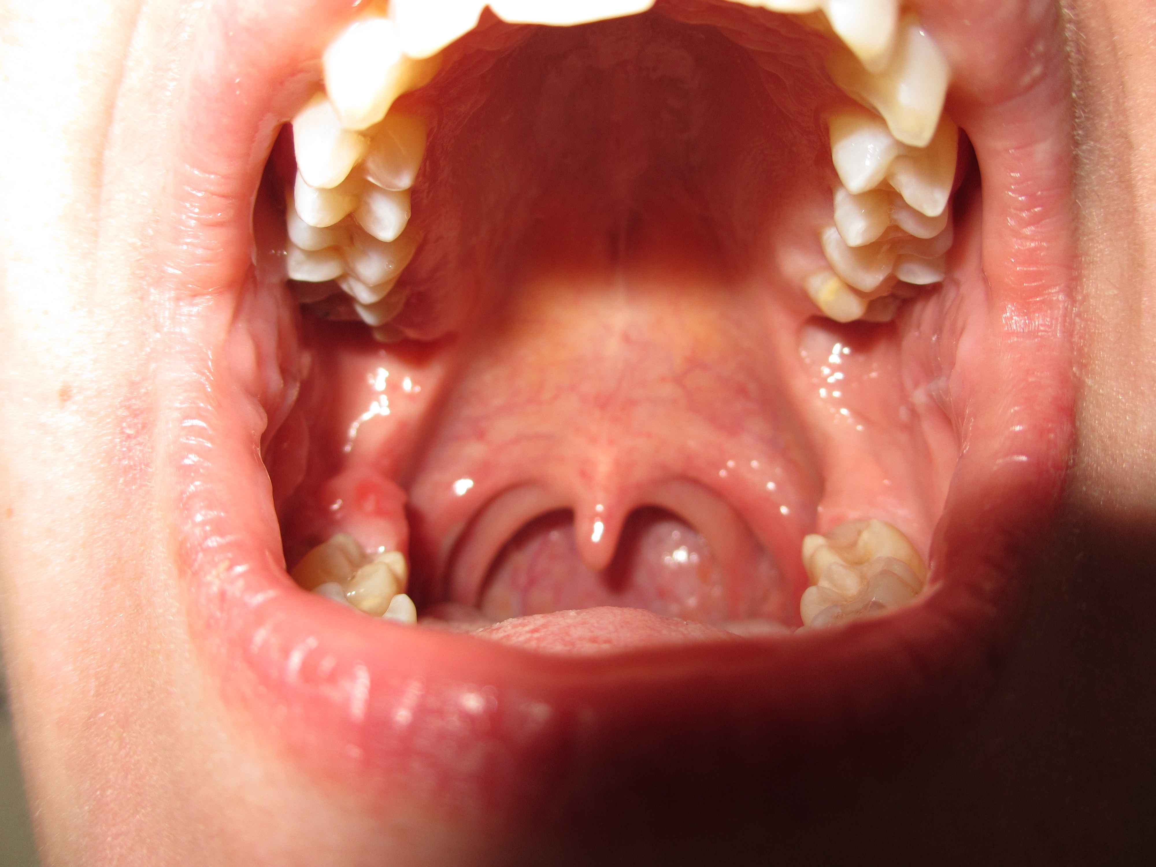 46++ Gutartiger tumor im mund bilder , Mundschleimhaut verändert &gt; Krebs (Tumor)