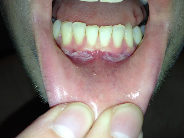 Mundschleimhautentzundung Wie Lange Dauert Das Noch Entzundung Mund Schleimhaut Mundschleimhautentzundung Wie Lange Dauert Das Noch Entzundung Mund Schleimhaut