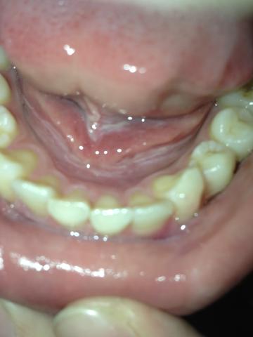 Unter der Zunge - (Entzündung, Mund, Schleimhaut)