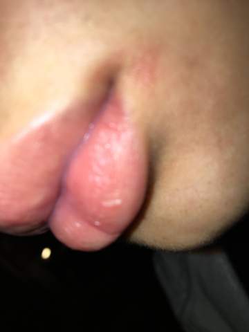 - (Gesundheit und Medizin, Lippe, Mundwinkel)