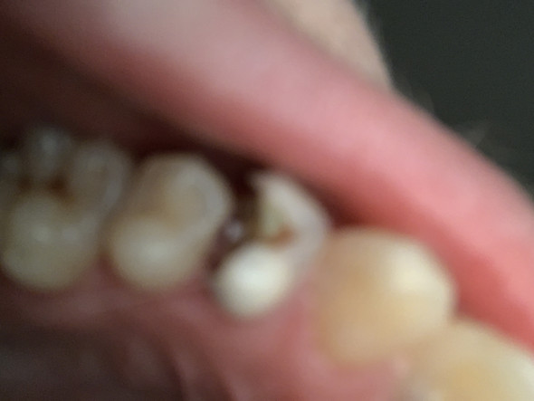 Grau zahn kind wird Zahn, Zahnfarbe,