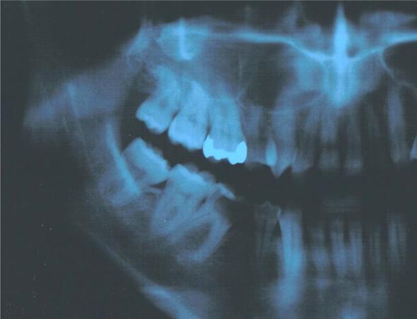 Dritter Zahn von links unten - (Zähne, Zahnarzt, Zahnmedizin)