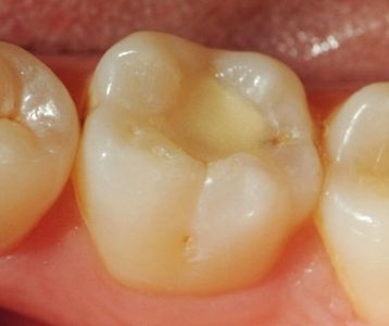 Zahn - (Gesundheit, Zähne, Zahnarzt)