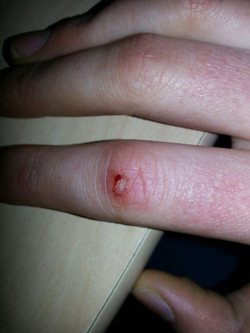 Muss Ich Damit Zum Arzt Schnitt Finger Muss Ich Damit Zum Arzt Schnitt Finger