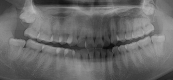 OPG Aufnahme - (Zähne, Zahnarzt, Zahnmedizin)