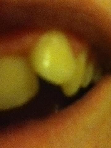 Mein abstehender Zahn, der glaube ich nicht in die Lücke passt. - (Angst, Kieferorthopäde)