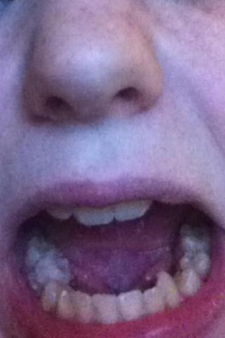 Unteren Zähne - (Angst, Kieferorthopäde)