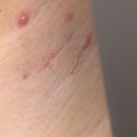 pickel in achsel pickel in achsel