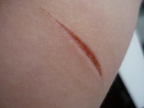 Muss Ich Mit Dieser Schnittwunde Zum Arzt Gesundheit Und Medizin Gesundheit Haut Muss Ich Mit Dieser Schnittwunde Zum Arzt Gesundheit Und Medizin Gesundheit Haut