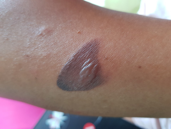 Verbrennung am Arm - ca 2cm groß - (Arzt, Verbrennung)