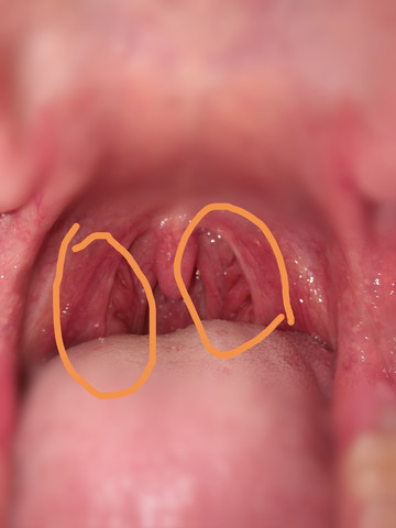 Umkreiste Stelle bild 1 - (Gesundheit, Krebs, Tumor)