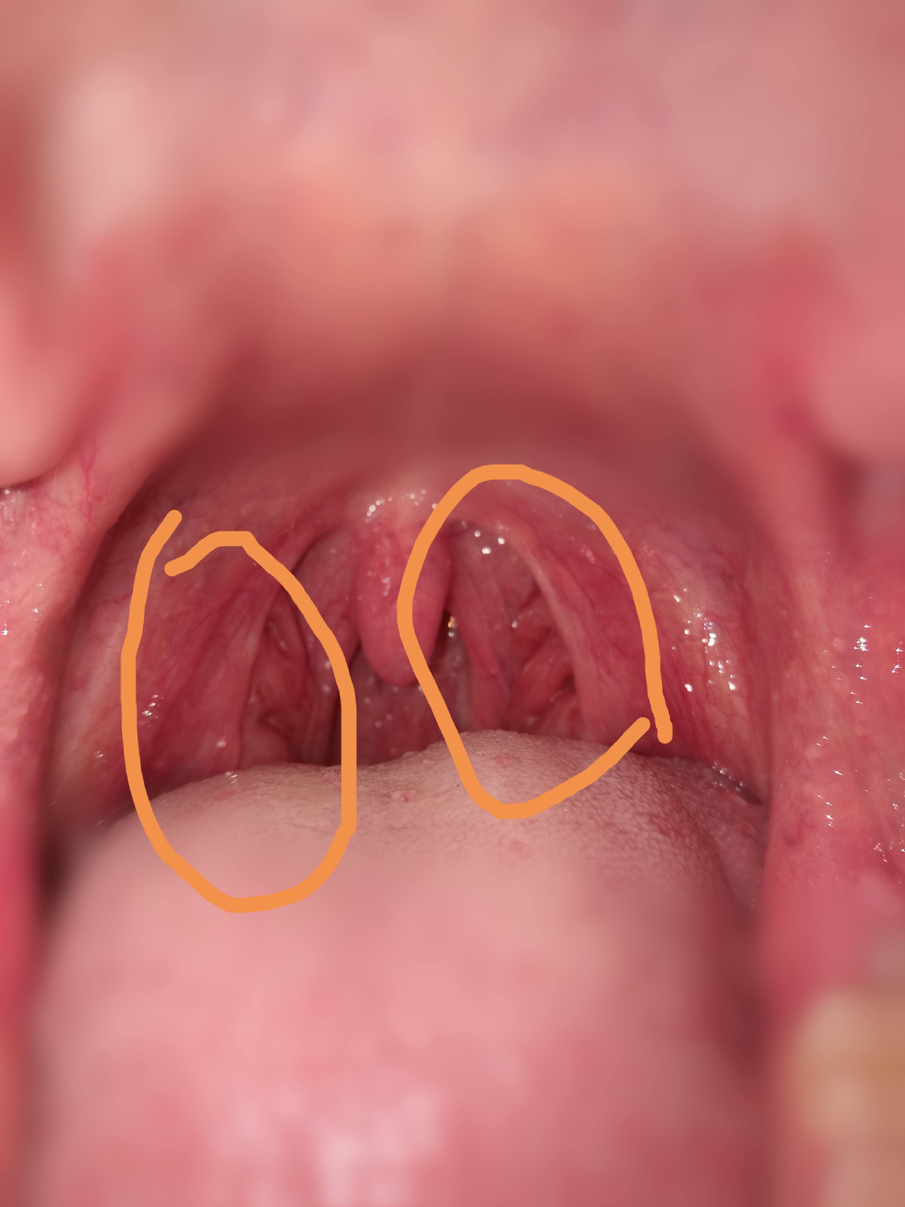 Muss ich zum Arzt, krebs? (Gesundheit, Tumor, Rachen)
