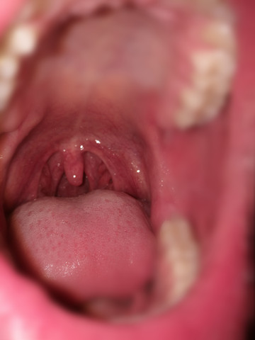 Muss Ich Zum Arzt Krebs Gesundheit Tumor Rachen Muss Ich Zum Arzt Krebs Gesundheit Tumor Rachen