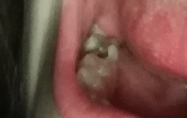 Muss meine Freundin ihren Zahn ziehen lassen? (Zähne, Ärzte)