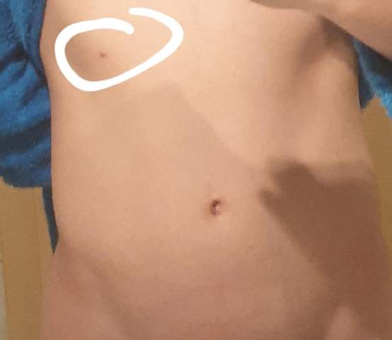 muttermal am bauch wegbekommen