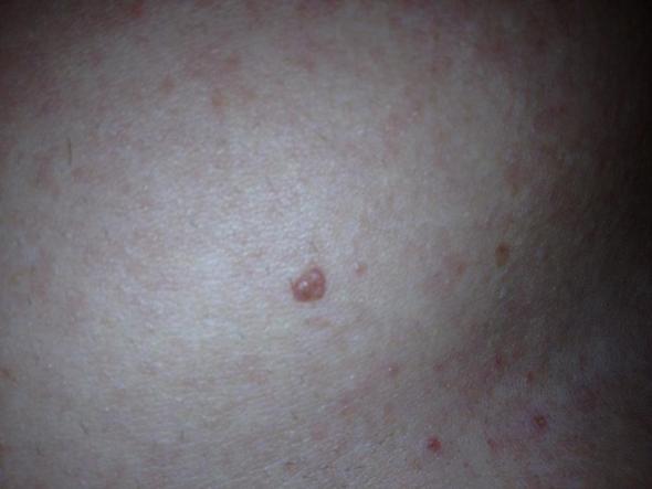 44+ Braune flecken unter der brust bilder , Muttermal auf der Brust (Hautkrebs)