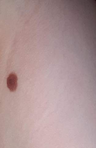 Muttermal Aussehen Schlimm Gesundheit Und Medizin Haut Muttermal Aussehen Schlimm Gesundheit Und Medizin Haut