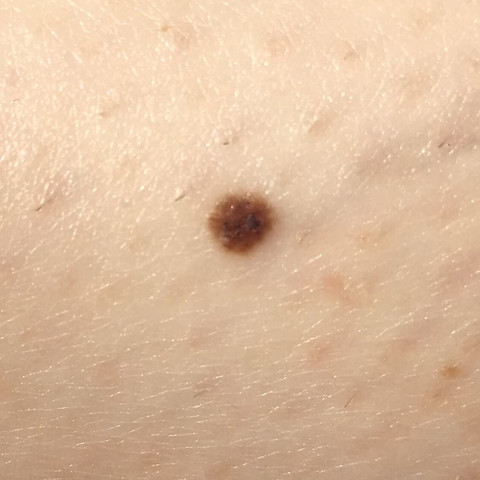 Muttermal Bedenklich Muttermal Bedenklich