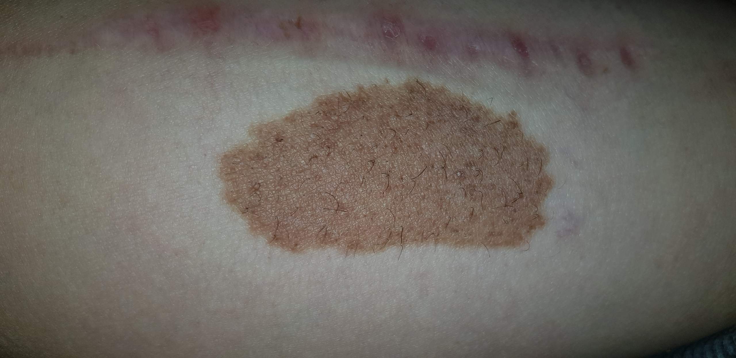 Muttermal entfernen lassen es wächst und brennt seit Monaten wie Hölle ? (Hautkrebs)