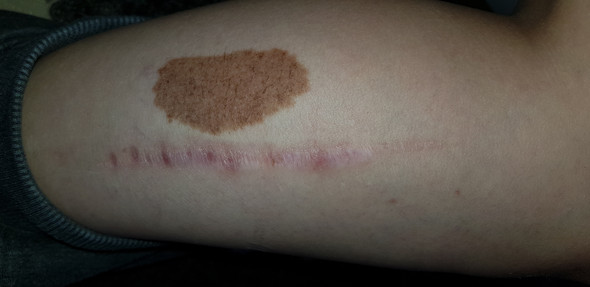 muttermal entfernen lassen es wachst