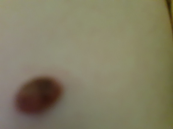 Muttermal Farbt Sich Nach Verwendung Von Apfelessig Farbung Muttermal Farbt Sich Nach Verwendung Von Apfelessig Farbung