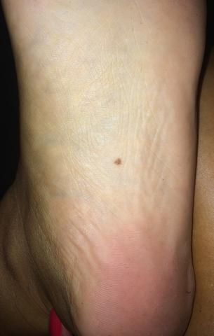 Fußsohle - (Hautarzt, Muttermal)