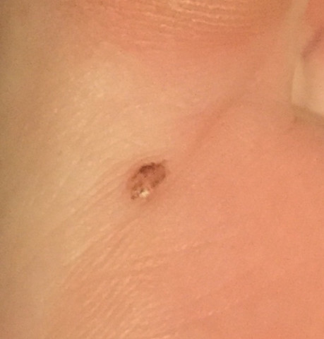 Muttermal Fusssohle Und Zeh Muttermalentfernung Hautkrebsvorsorge Muttermal Fusssohle Und Zeh Muttermalentfernung Hautkrebsvorsorge